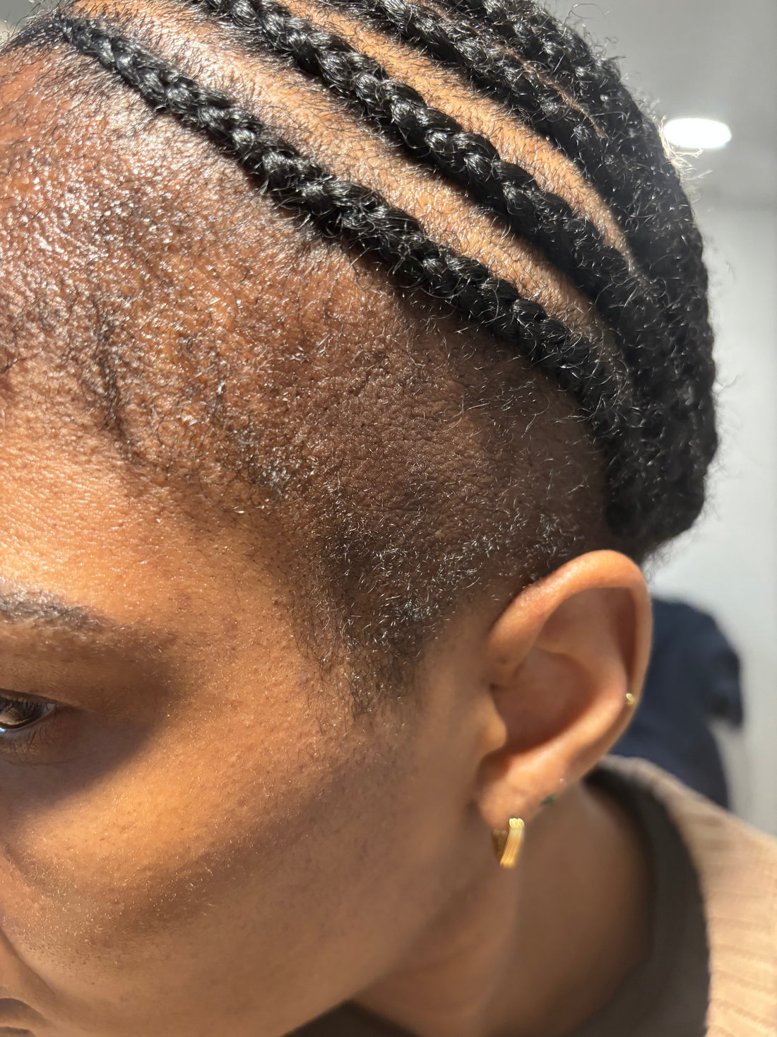 When Your Hairline Changes, Your Confidence Does Too