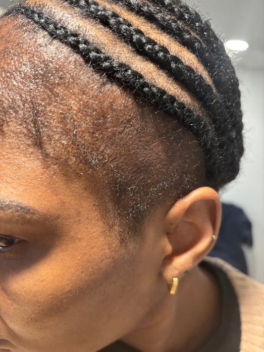 When Your Hairline Changes, Your Confidence Does Too